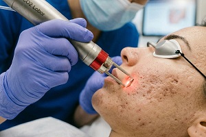 How Modern Techniques Help Reduce Deep Acne Scars