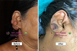 before and after results_3