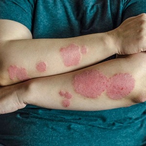 Scalp Treatment for Hair Growth