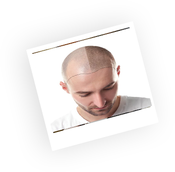 consult best hair specialist in Pune