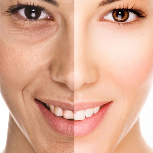 microdermabrasion skin treatment Pune