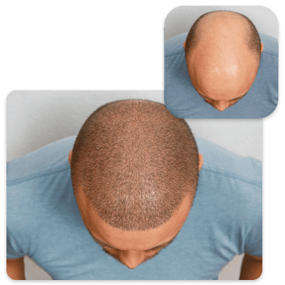 FUE Hair Treatment in Pune