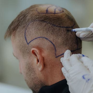 Hair Concerns Treated with Hair Transplant