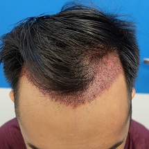 Hair Transplant