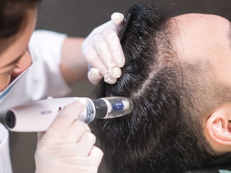 PRP hair treatment in Pune showing PRP therapy for hair growth and hair loss control