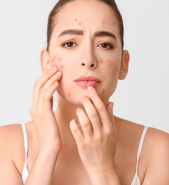 Acne marks treatment in Pune by experienced acne scar dermatologist