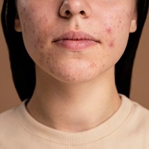 Acne Scar Treatment - skin dermatologist in pune