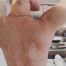 Body Peel Treatment - skin dermatologist in pune