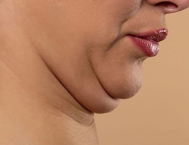 botox for facial contouring