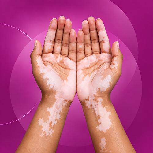 Vitiligo Treatment Cost in Pune