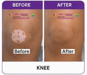 Vitiligo Before After 10