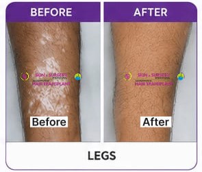 Vitiligo Before After 11