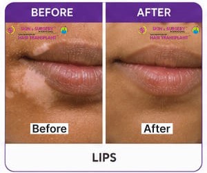 Vitiligo Before After 13