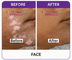 Vitiligo Before After 5
