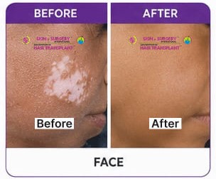 Vitiligo Before After 7