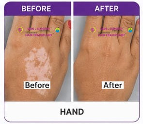 Vitiligo Before After 9