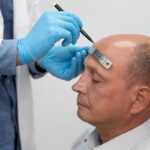 best-fue-hair-transplant-process-recovery-results