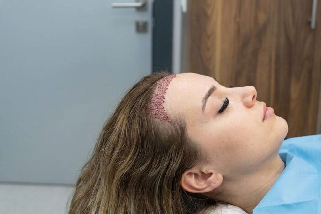 FUE Hair Transplant for Women â Is It Effective? fue-hair-transplant-for-women-is-it-effective