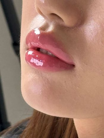lip-fillers-in-pune